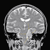 陳淑莊指其腦瘤壓着腦幹，以致腦幹彎曲。（互聯網圖片）