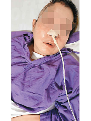許太接受開顱手術逾半年，仍未獲安排重置頭骨。
