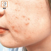 部分人使用家用美容儀後，可能引致皮膚敏感。