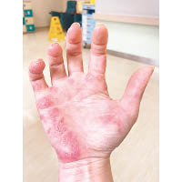 紅斑狼瘡患者皮膚被抗體攻擊，會出現紅疹。