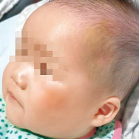 事主兒子左額及左臉被打至紅腫。