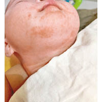 嬰兒濕疹常見於面部、手腳等的摺位（受訪者提供）