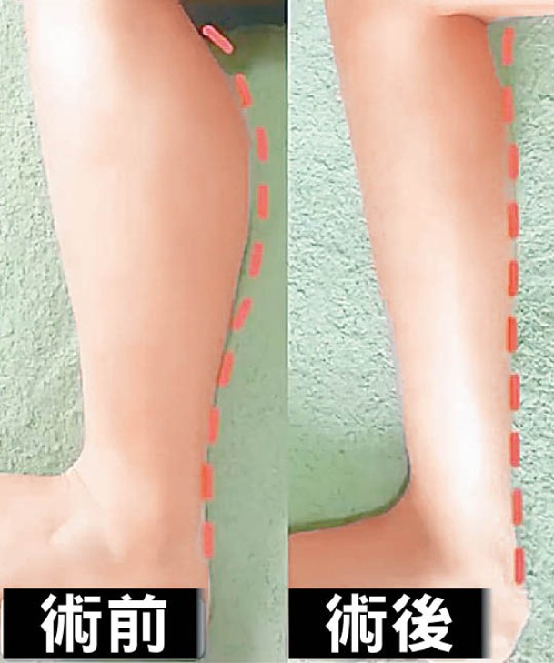 手術聲稱永久瘦腿，但極具損害性，傷害不可逆轉。