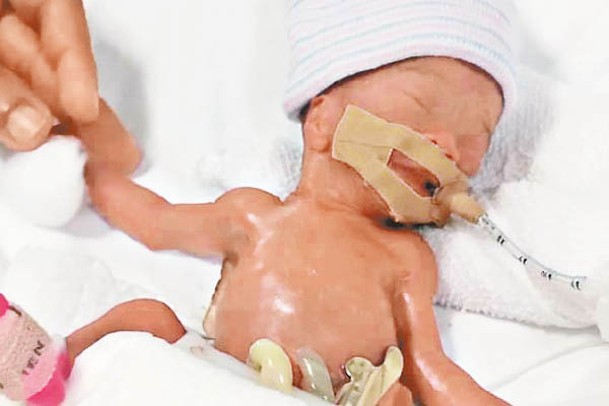 郭玉媗相信是全球最小的存活早產嬰兒。