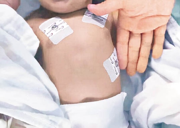 嬰兒入院時皮膚發紫。