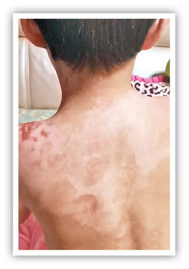 女童肩膀及背部有多處疤痕。