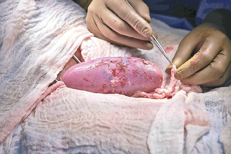 豬腎被連接至病人的血管。