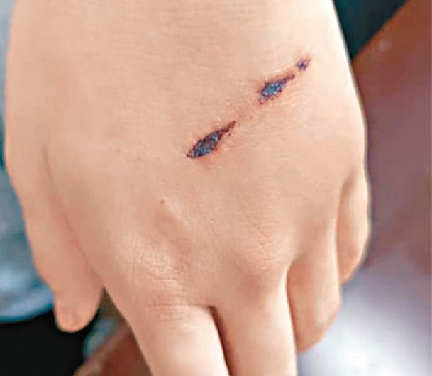 小愛的手上有傷痕。