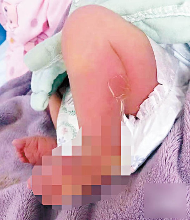 女嬰的臀部和腿部出現紅腫、水泡和脫皮等症狀。