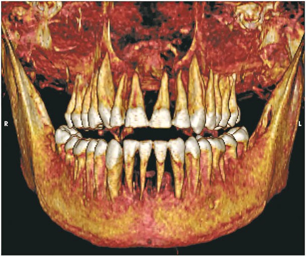 木乃伊的牙齒結構完整。