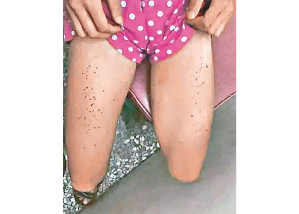 涉事女童被燙傷的大腿。