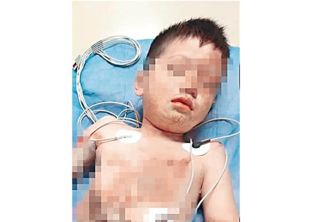 7歲仔遭電擊燒傷  截肢命危