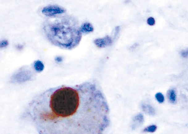 柏金遜症患者大腦存在「α-突觸核蛋白」（棕點）。