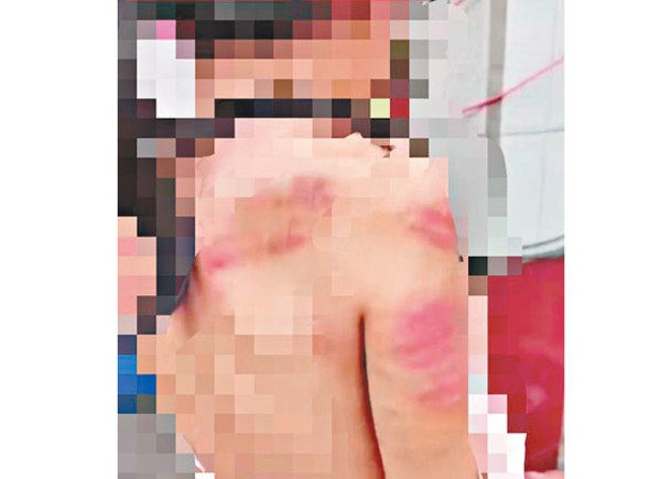 小學女生遭體罰渾身傷  拘教師