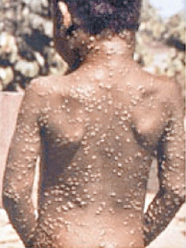 克盧格促請社區團體和領袖等協助民眾加強認識猴痘。