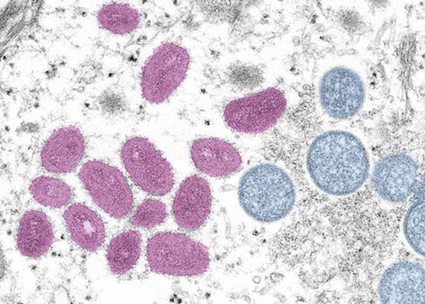 15州份35宗感染  美國提升猴痘風險級別