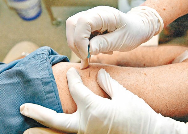 美國加碼增購天花疫苗。（Getty Images圖片）