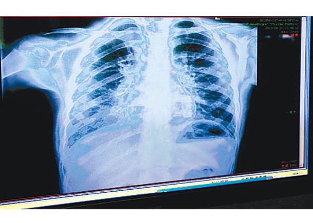 內地南方省市爆發流感。圖為患者肺部的X光照片。