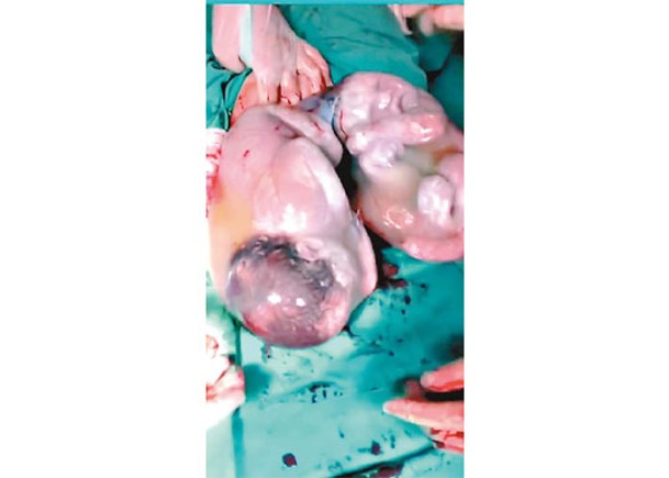 巴西雙胞胎  出生未破羊水袋