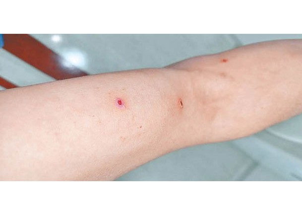部分猴痘患者皮膚會出現傷口。