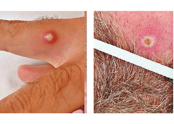 左及右圖：病人身上出現猴痘病徵。