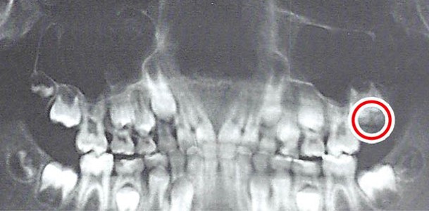 斯卡佩利的智慧齒影響臼齒生長（紅圈示）。（黑白圖片）