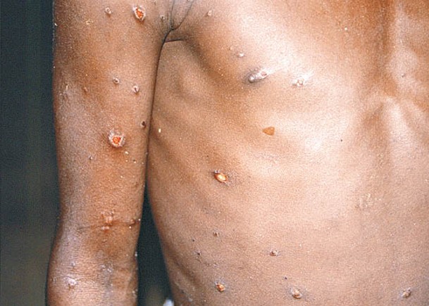 猴痘疫情蔓延多國。