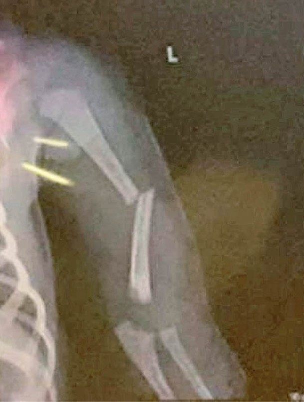 男嬰左手肱骨明顯斷裂及移位。