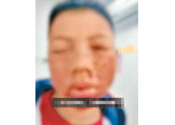 西安9歲男童放鞭炮  炸傷面險盲