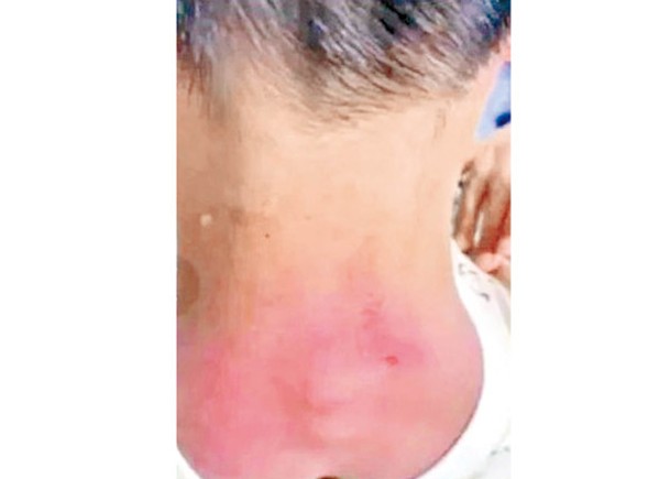 男童遭補習老師毆打，頸部出現傷痕。