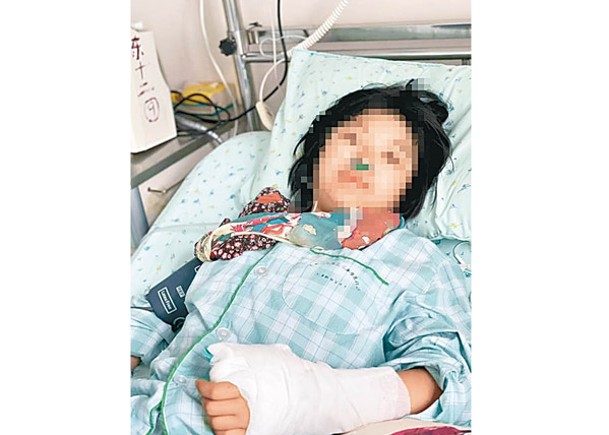 小娟手掌骨折入院。