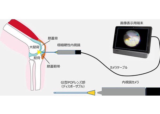 目前新內窺鏡只適用於膝關節傷病的檢查上。