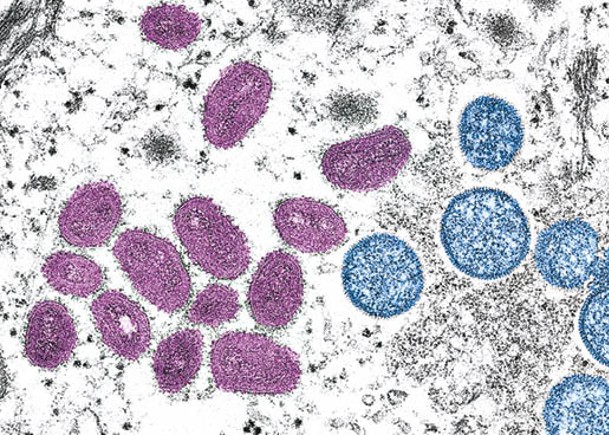瀋陽市有人確診感染猴痘，圖為顯微鏡下的猴痘病毒。