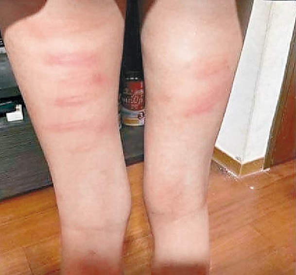 女童的大腿滿布藤條印。