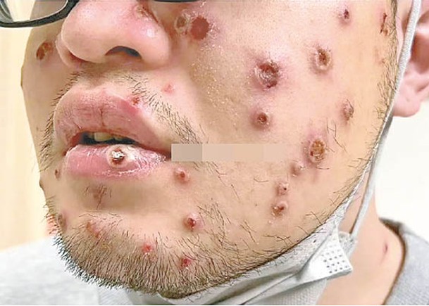 猴痘患者面上也會出皮疹。