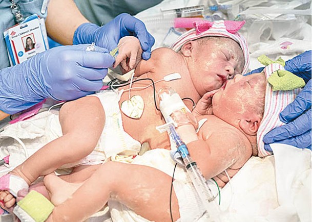 連體雙胞胎姊妹在醫院出生。