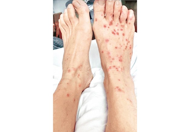 猴痘患者皮膚會出皮疹。