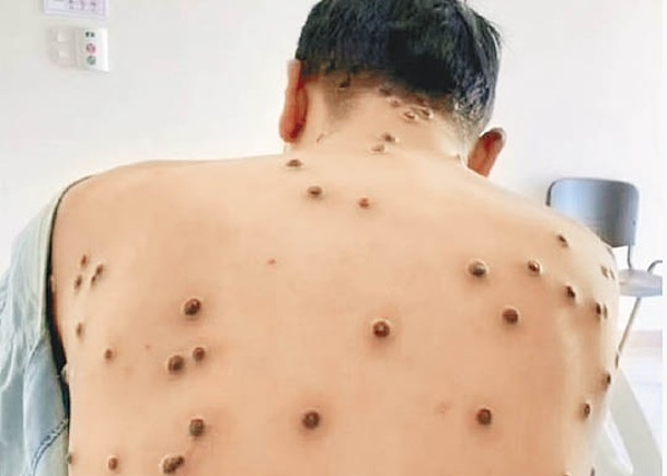 猴痘患者會出皮疹。