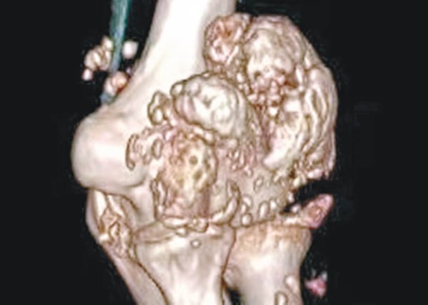 醫生透過手術取出「珍珠」狀的滑膜軟骨瘤。