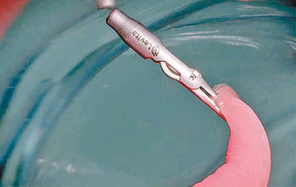 小磁鐵附在肝臟等器官上，醫生可用機械臂來操縱。