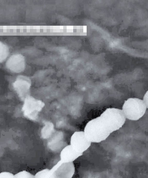 甲型鏈球菌在日本蔓延。