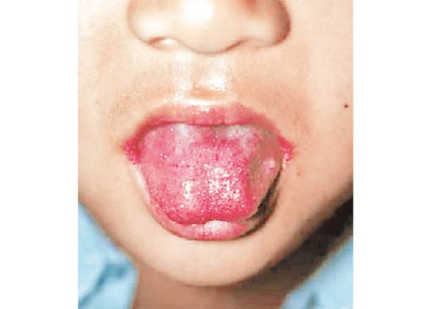 患者舌頭往往呈現紅色。
