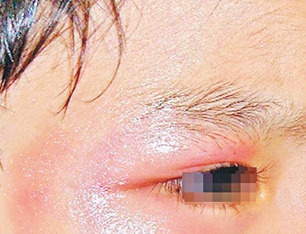 事主受虐眼部出現紅腫。