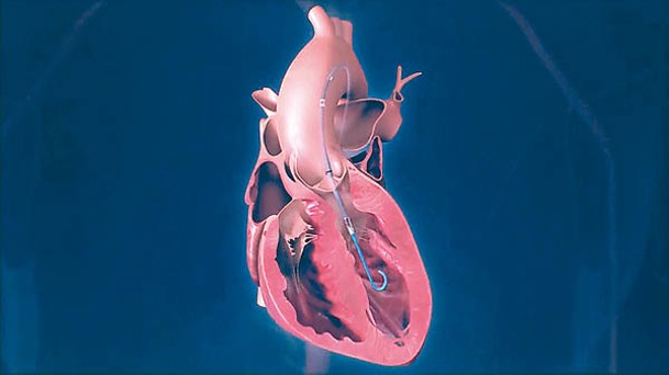 FDA下令回收一款心臟泵。