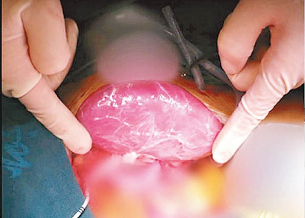 豬腎（圖）在患者體內功能良好，可正常產生尿液。