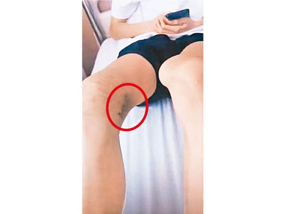 羅男右膝組織（紅圈示）遭醫生切掉。