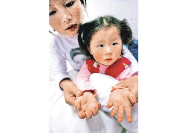 手足口病是一種由腸病毒引起的傳染病。