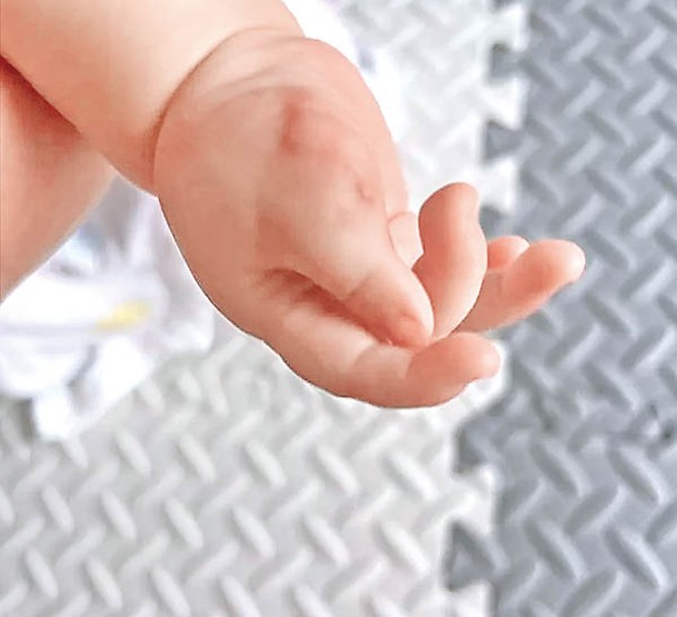 嬰兒手術後拇指恢復正常。