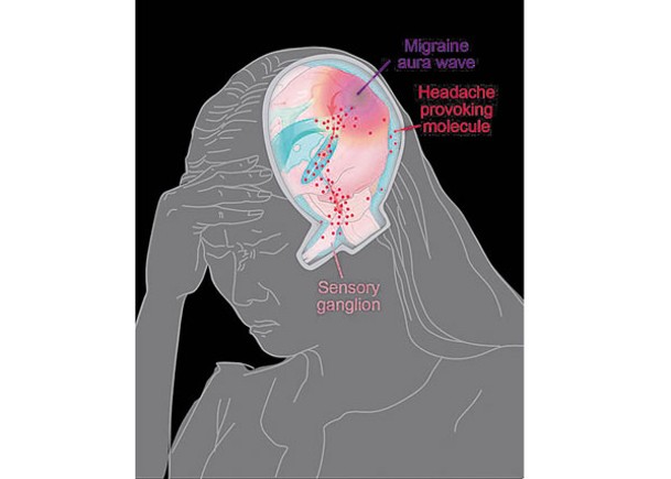 研究團隊發現引起偏頭痛新成因；圖為示意圖。
