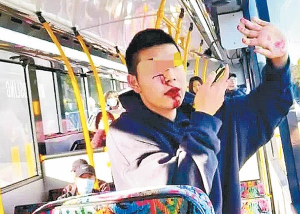 一名中國留學生在巴士上遭人持械襲擊，面部嚴重損傷。